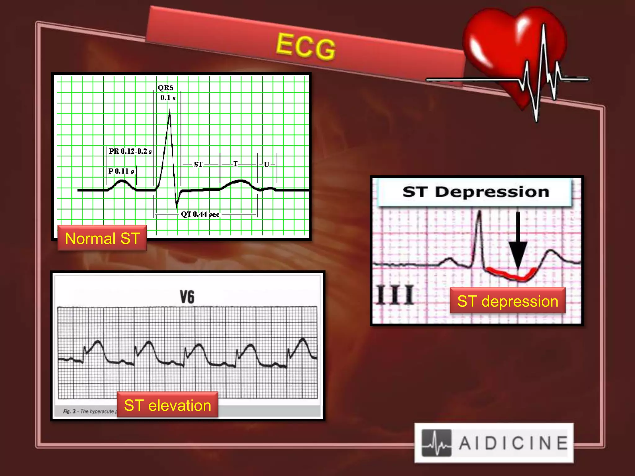 Normal ST


                      ST depression




       ST elevation
 