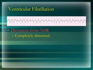 Ventricular Fibrillation
• Deviation from NSR
– Completely abnormal.
 