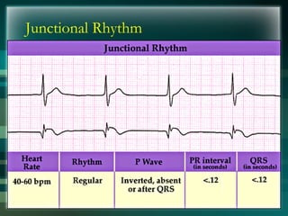 Junctional Rhythm
 