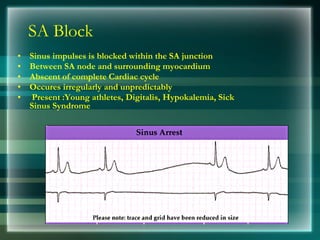 SA Block
• Sinus impulses is blocked within the SA junction
• Between SA node and surrounding myocardium
• Abscent of complete Cardiac cycle
• Occures irregularly and unpredictably
• Present :Young athletes, Digitalis, Hypokalemia, Sick
Sinus Syndrome
 