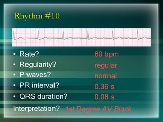 Rhythm #10
60 bpm• Rate?
• Regularity? regular
normal
0.08 s
• P waves?
• PR interval? 0.36 s
• QRS duration?
Interpretation? 1st Degree AV Block
 