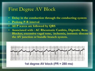 First Degree AV Block
• Delay in the conduction through the conducting system
• Prolong P-R interval
• All P waves are followed by QRS
• Associated with : AC Rheumatic Carditis, Digitalis, Beta
Blocker, excessive vagal tone, ischemia, intrinsic disease in
the AV junction or bundle branch system.
 