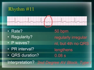 Rhythm #11
50 bpm• Rate?
• Regularity? regularly irregular
nl, but 4th no QRS
0.08 s
• P waves?
• PR interval? lengthens
• QRS duration?
Interpretation? 2nd Degree AV Block, Type I
 