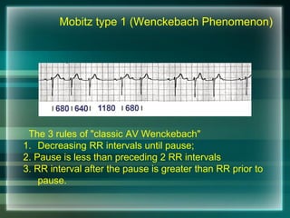 The 3 rules of "classic AV Wenckebach"
1. Decreasing RR intervals until pause;
2. Pause is less than preceding 2 RR intervals
3. RR interval after the pause is greater than RR prior to
pause.
Mobitz type 1 (Wenckebach Phenomenon)
 