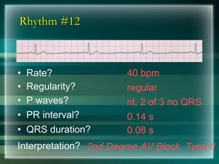 Rhythm #12
40 bpm• Rate?
• Regularity? regular
nl, 2 of 3 no QRS
0.08 s
• P waves?
• PR interval? 0.14 s
• QRS duration?
Interpretation? 2nd Degree AV Block, Type II
 