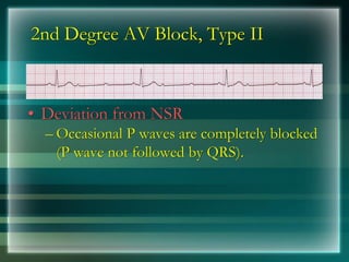 2nd Degree AV Block, Type II
• Deviation from NSR
– Occasional P waves are completely blocked
(P wave not followed by QRS).
 