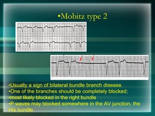 •Mobitz type 2
•Usually a sign of bilateral bundle branch disease.
•One of the branches should be completely blocked;
•most likely blocked in the right bundle
•P waves may blocked somewhere in the AV junction, the
His bundle.
 