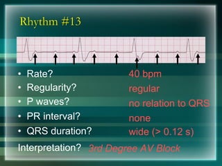 Rhythm #13
40 bpm• Rate?
• Regularity? regular
no relation to QRS
wide (> 0.12 s)
• P waves?
• PR interval? none
• QRS duration?
Interpretation? 3rd Degree AV Block
 