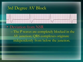 3rd Degree AV Block
• Deviation from NSR
– The P waves are completely blocked in the
AV junction; QRS complexes originate
independently from below the junction.
 