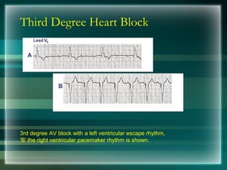 Third Degree Heart Block
3rd degree AV block with a left ventricular escape rhythm,
'B' the right ventricular pacemaker rhythm is shown.
 