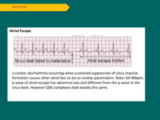 RHYTHM
Atrial Escape
a cardiac dysrhythmia occurring when sustained suppression of sinus impulse
formation causes other atrial foci to act as cardiac pacemakers. Rate= 60-80bpm,
p wave of atrial escape has abnormal axis and different from the p wave in the
sinus beat. However QRS complexes look exactly the same.
 