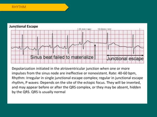 RHYTHM
Junctional Escape
Depolarization initiated in the atrioventricular junction when one or more
impulses from the sinus node are ineffective or nonexistent. Rate: 40-60 bpm,
Rhythm: Irregular in single junctional escape complex; regular in junctional escape
rhythm, P waves: Depends on the site of the ectopic focus. They will be inverted,
and may appear before or after the QRS complex, or they may be absent, hidden
by the QRS. QRS is usually normal
 