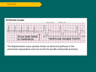 RHYTHM
Ventricular escape
The depolarization wave spreads slowly via abnormal pathway in the
ventricular myocardium and not via the His bundle and bundle branches.
 