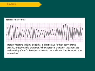 RHYTHM
Torsades de Pointes
literally meaning twisting of points, is a distinctive form of polymorphic
ventricular tachycardia characterized by a gradual change in the amplitude
and twisting of the QRS complexes around the isoelectric line. Rate cannot be
determined.
 