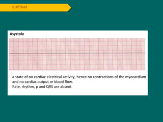 RHYTHM
Asystole
a state of no cardiac electrical activity, hence no contractions of the myocardium
and no cardiac output or blood flow.
Rate, rhythm, p and QRS are absent
 