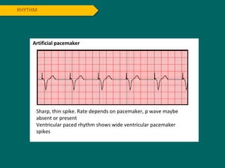 RHYTHM
Artificial pacemaker
Sharp, thin spike. Rate depends on pacemaker, p wave maybe
absent or present
Ventricular paced rhythm shows wide ventricular pacemaker
spikes
 