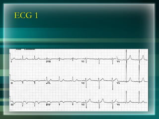 ECG 1
 