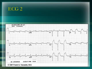 ECG 2
 