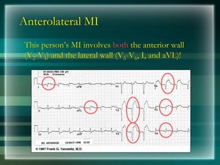 Anterolateral MI
This person’s MI involves both the anterior wall
(V2-V4) and the lateral wall (V5-V6, I, and aVL)!
 
