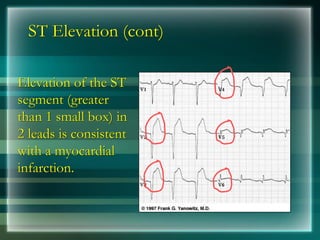 ST Elevation (cont)
Elevation of the ST
segment (greater
than 1 small box) in
2 leads is consistent
with a myocardial
infarction.
 