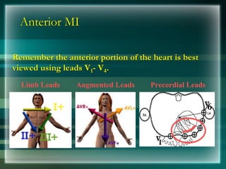 Anterior MI
Remember the anterior portion of the heart is best
viewed using leads V1- V4.
Limb Leads Augmented Leads Precordial Leads
 
