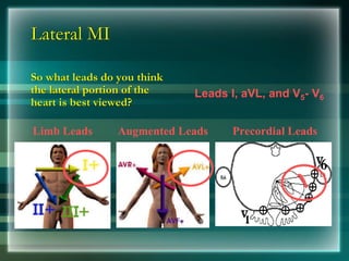 Lateral MI
So what leads do you think
the lateral portion of the
heart is best viewed?
Limb Leads Augmented Leads Precordial Leads
Leads I, aVL, and V5- V6
 