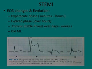 STEMI
• ECG changes & Evolution:
– Hyperacute phase ( minutes – hours )
– Evolved phase ( over hours)
– Chronic Stable Phase( over days– weeks )
– Old MI.
`
 