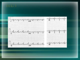 ECG 3
 