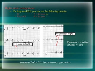 Right atrial enlargement
– To diagnose RAE you can use the following criteria:
• II P > 2.5 mm, or
• V1 or V2 P > 1.5 mm
Remember 1 small box
in height = 1 mm
A cause of RAE is RVH from pulmonary hypertension.
> 2 ½ boxes (in height)
> 1 ½ boxes (in height)
 