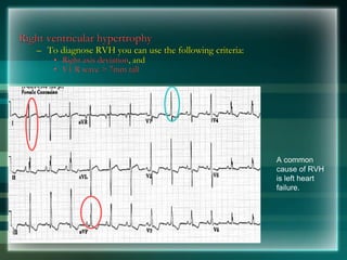 Right ventricular hypertrophy
– To diagnose RVH you can use the following criteria:
• Right axis deviation, and
• V1 R wave > 7mm tall
A common
cause of RVH
is left heart
failure.
 