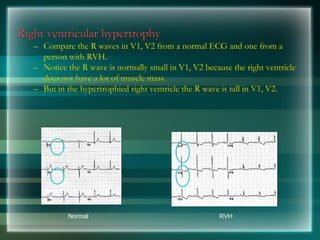 Right ventricular hypertrophy
– Compare the R waves in V1, V2 from a normal ECG and one from a
person with RVH.
– Notice the R wave is normally small in V1, V2 because the right ventricle
does not have a lot of muscle mass.
– But in the hypertrophied right ventricle the R wave is tall in V1, V2.
Normal RVH
 