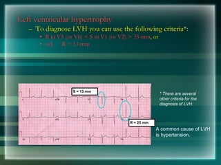 Left ventricular hypertrophy
– To diagnose LVH you can use the following criteria*:
• R in V5 (or V6) + S in V1 (or V2) > 35 mm, or
• avL R > 13 mm
A common cause of LVH
is hypertension.
* There are several
other criteria for the
diagnosis of LVH.
S = 13 mm
R = 25 mm
 