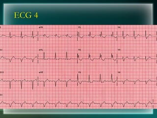 ECG 4
 