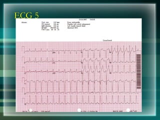 ECG 5
 
