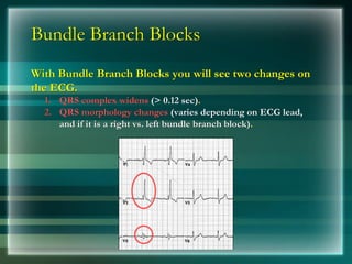 Bundle Branch Blocks
With Bundle Branch Blocks you will see two changes on
the ECG.
1. QRS complex widens (> 0.12 sec).
2. QRS morphology changes (varies depending on ECG lead,
and if it is a right vs. left bundle branch block).
 