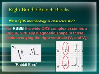Right Bundle Branch Blocks
What QRS morphology is characteristic?
V1
For RBBB the wide QRS complex assumes a
unique, virtually diagnostic shape in those
leads overlying the right ventricle (V1 and V2).
“Rabbit Ears”
 