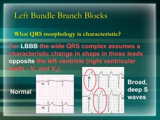 Left Bundle Branch Blocks
What QRS morphology is characteristic?
For LBBB the wide QRS complex assumes a
characteristic change in shape in those leads
opposite the left ventricle (right ventricular
leads - V1 and V2).
Broad,
deep S
waves
Normal
 