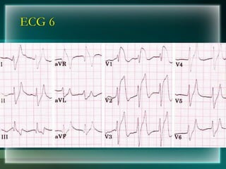 ECG 6
 