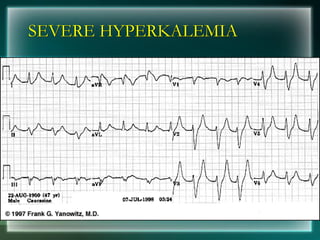 SEVERE HYPERKALEMIA
 