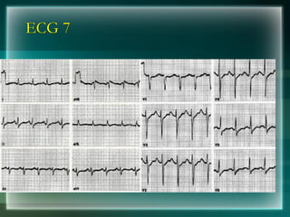 ECG 7
 