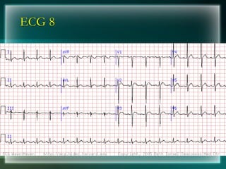 ECG 8
 