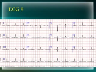 ECG 9
 