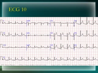 ECG 10
 