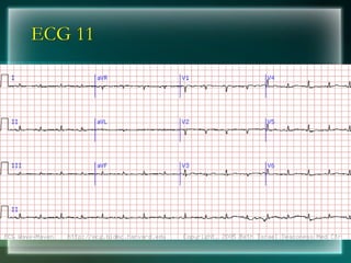 ECG 11
 