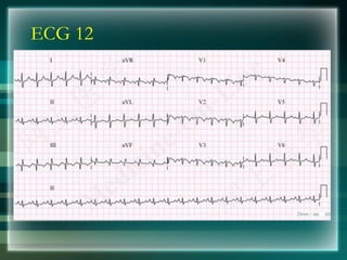 ECG 12
 