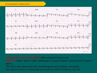 PULMONARY EMBOLISM
Tachycardia and incomplete RBBB differentiated PE from no PE.
SIQIIITIII = deep S wave in lead I, pathological Q wave in lead III, and inverted T wave in
lead III.
The ECG is often abnormal in PE, but findings are not sensitive, not specific
Any cause of acute cor pulmonale can cause the S1Q3T3 finding on the ECG.
 