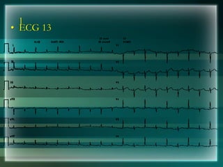 l
• ECG 13
 
