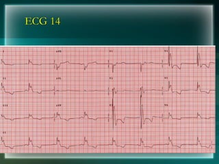 ECG 14
 
