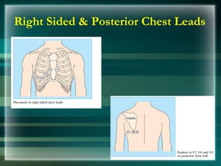 Right Sided & Posterior Chest Leads
 