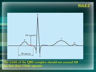 RULE 2
The width of the QRS complex should not exceed 110
ms, less than 3 little squares
 